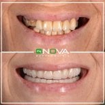 Before and after veneers at My Nova Kusadasi Dental Clinic, smile makeover results