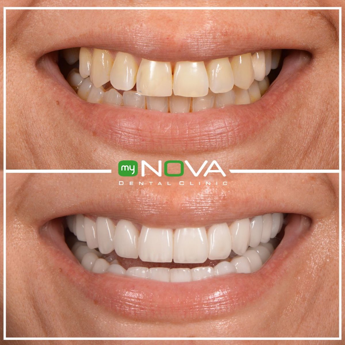 نتائج قبل وبعد الفينير في My Nova Kusadasi Dental Clinic، تحول الابتسامة
