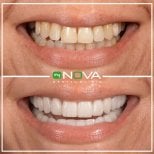 Before and after veneers at My Nova Kusadasi Dental Clinic, smile transformation result