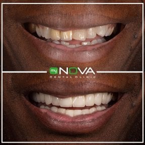 Before and after veneers at My Nova Kusadasi Dental Clinic, smile transformation results