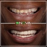 Before and after veneers at My Nova Kusadasi Dental Clinic, smile transformation results