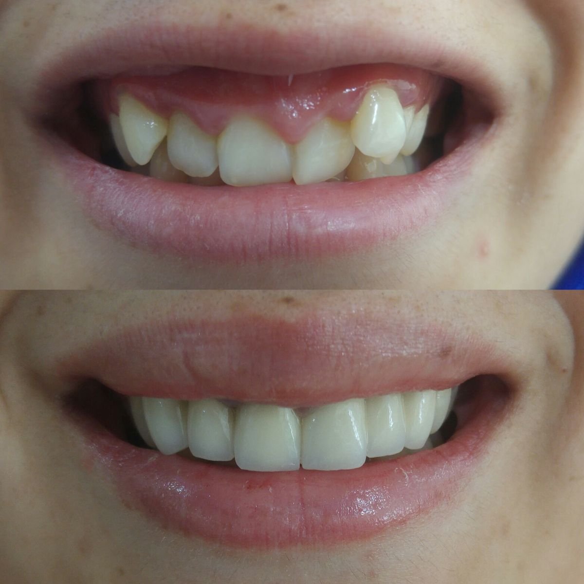 قبل وبعد الفينير في My Nova Kusadasi Dental Clinic، نتائج تجميل الابتسامة