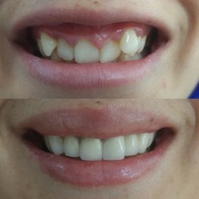 Before and after veneers at My Nova Kusadasi Dental Clinic, smile makeover results