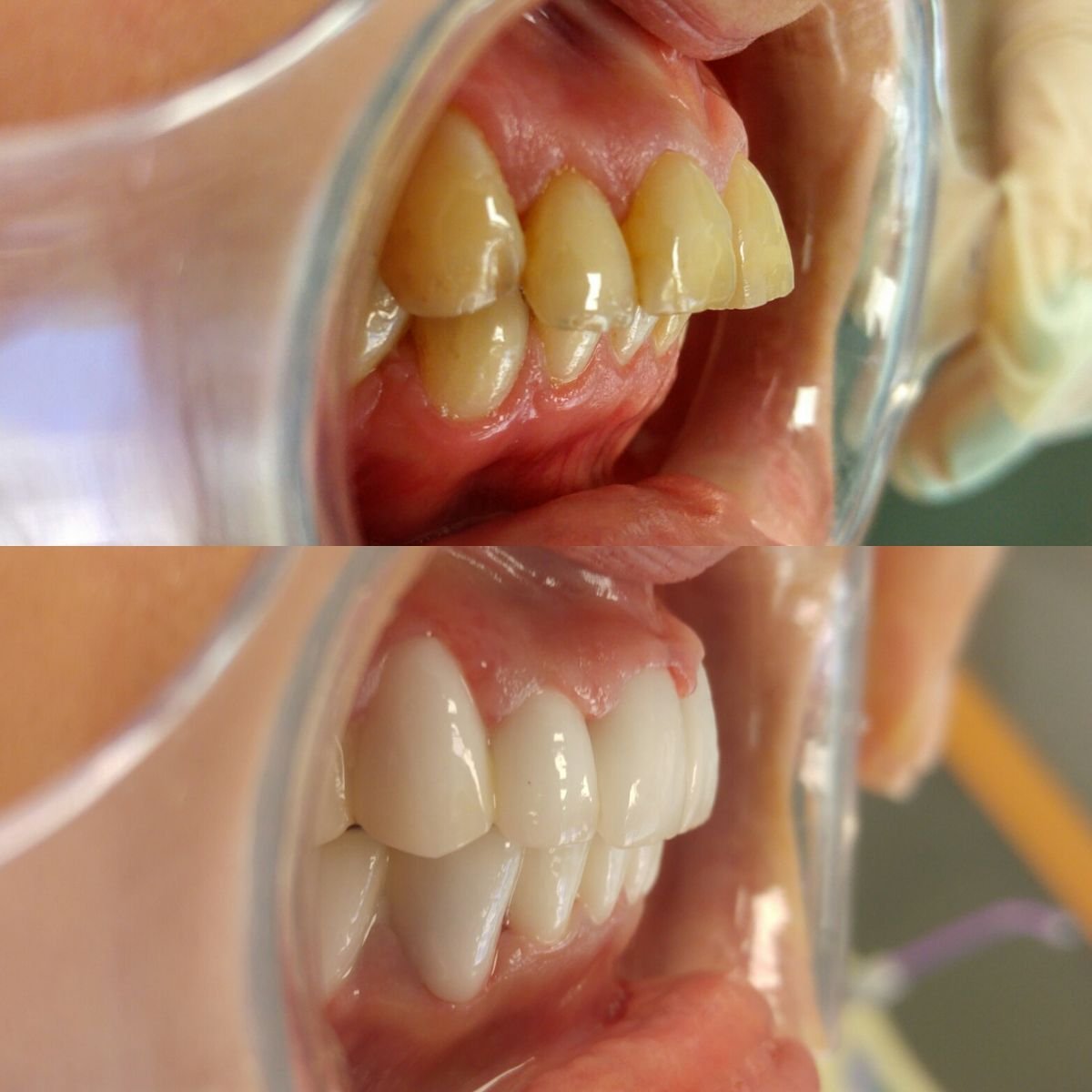 نتيجة قبل وبعد الفينير في My Nova Kusadasi Dental Clinic، تحول الابتسامة