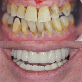 Before and after veneers at My Nova Kusadasi Dental Clinic, dramatic smile transformation result