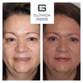 Before and after Deep Plane Facelift results at Clinica Granado Tiagonce, facial rejuvenation