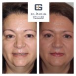 Before and after Deep Plane Facelift results at Clinica Granado Tiagonce, facial rejuvenation