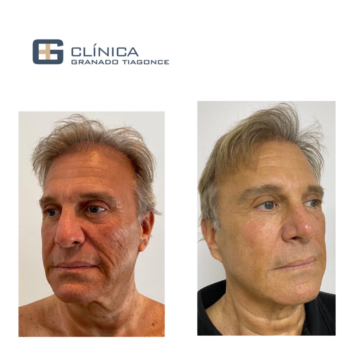 Resultados antes y después de deep plane facelift en Clinica Granado Tiagonce, rejuvenecimiento facial