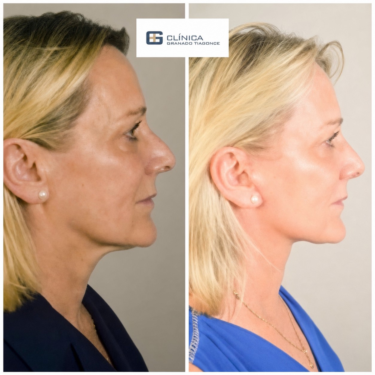 Resultados antes y después de deep plane facelift en Clinica Granado Tiagonce, rejuvenecimiento facial