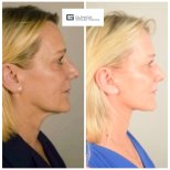 Before and after deep plane facelift results at Clinica Granado Tiagonce, facial rejuvenation