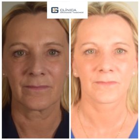 Before and after deep plane facelift results at Clinica Granado Tiagonce, facial rejuvenation