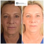 Before and after deep plane facelift results at Clinica Granado Tiagonce, facial rejuvenation