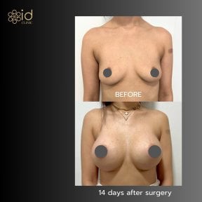 Before and after breast implants with lift at ID Clinic Bangkok, visible enhancement result