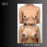 Before and after breast implants with lift at ID Clinic Bangkok, visible enhancement result