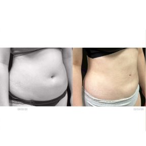 Before and after abdominal liposuction results at Yanhee International Hospital, slimmer waist