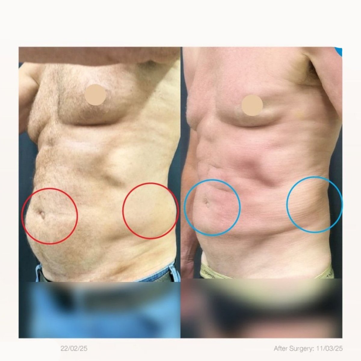 Vorher-nachher-Ergebnis der Bauchfettabsaugung in Yanhee International Hospital, flacher Bauch