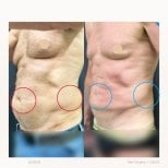 Resultados de liposucción abdominal antes y después en Yanhee International Hospital, abdomen plano
