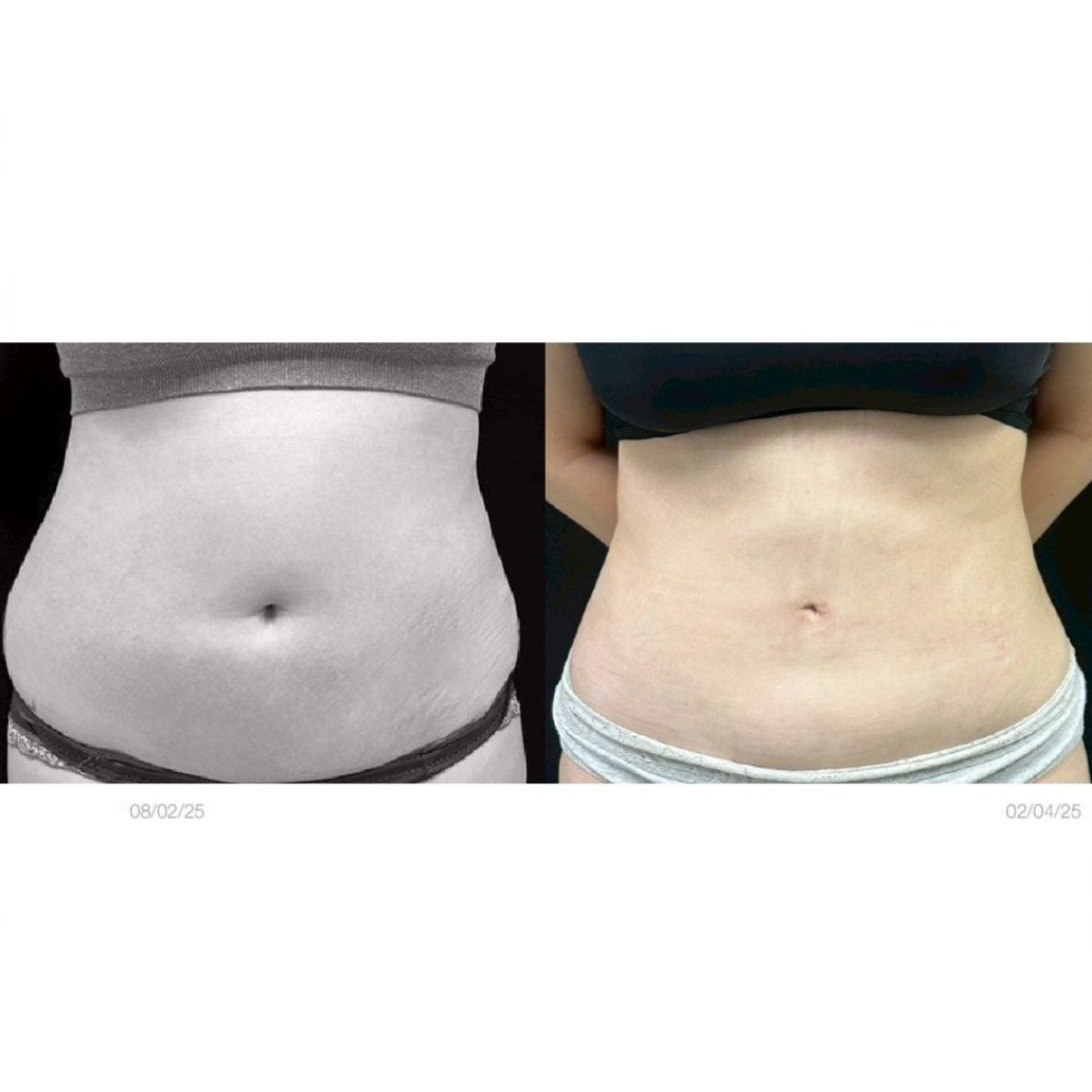 Vorher-nachher-Ergebnis der Bauchliposuktion in Yanhee International Hospital, schlankere Taille