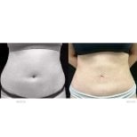 Resultados de liposucción abdominal antes y después en Yanhee International Hospital, cintura más delgada