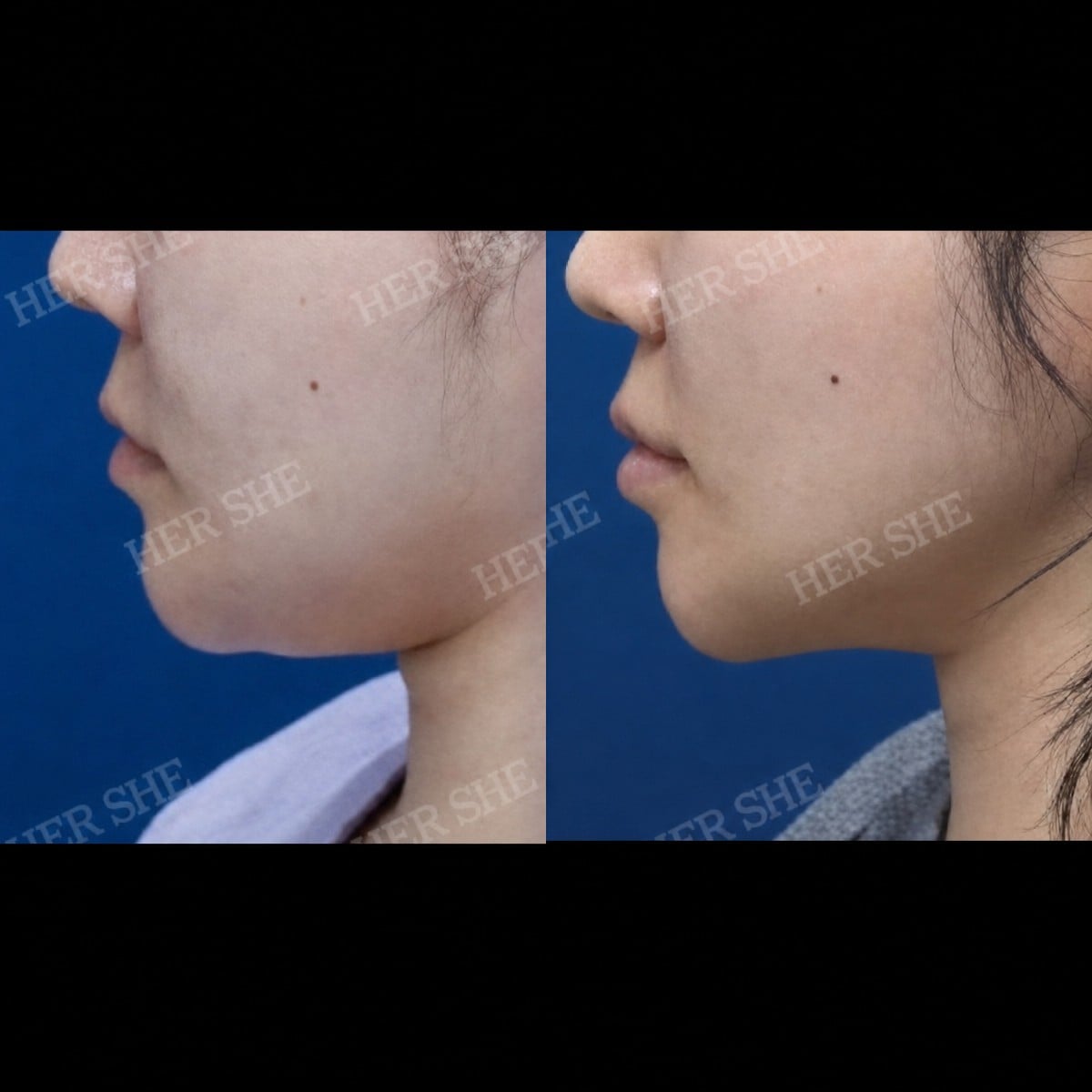 نتائج شد الوجه بالخيوط قبل وبعد في HERSHE Plastic Surgery Korea، تحديد الفك