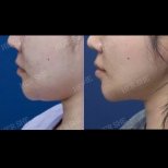 Результаты подтяжки нитями до и после в HERSHE Plastic Surgery Korea, коррекция линии челюсти