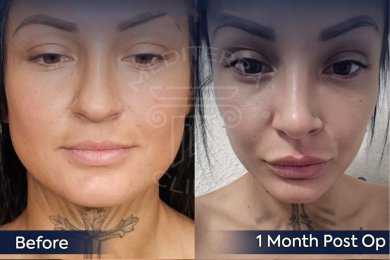 Vorher-nachher-Rhinoplastik-Ergebnis bei Dr. Safa Manav Clinic, Nasenkorrektur nach 1 Monat