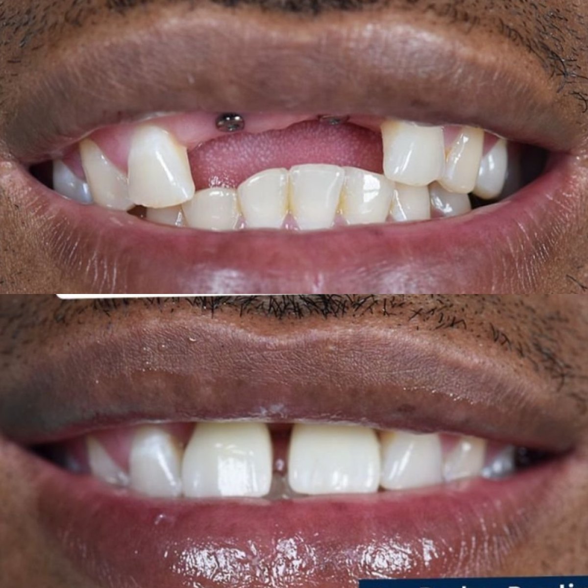 Resultados antes y después de implante dental en Paulino Almonte Dental Team, sonrisa restaurada