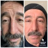 Before and after blepharoplasty results at Lokman Hekim University Ankara Hospital, eyelid lift