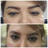 Before and after blepharoplasty results at Lokman Hekim University Ankara Hospital, eyelid lift