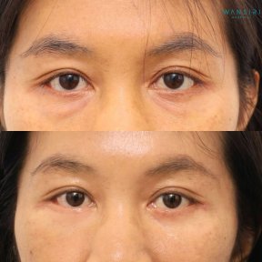 Before and after lower eyelid blepharoplasty results at Wansiri Hospital, reduced eye bags
