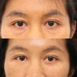 Before and after lower eyelid blepharoplasty results at Wansiri Hospital, reduced eye bags