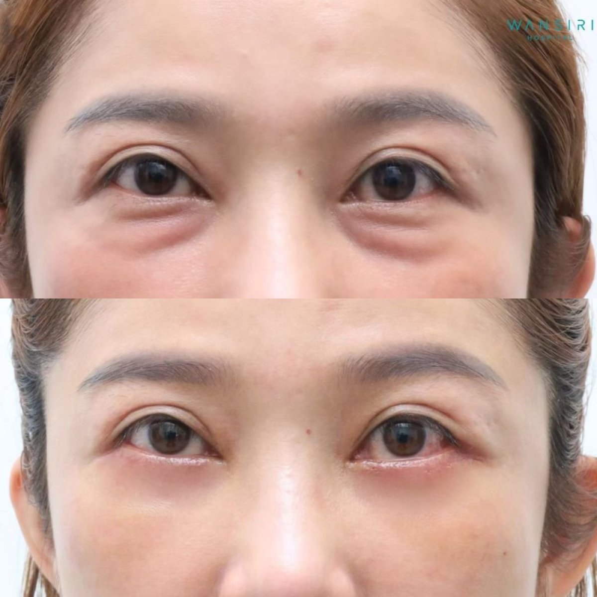 Resultados de blefaroplastia de párpado inferior antes y después en Wansiri Hospital