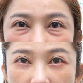 Before and after lower eyelid blepharoplasty results at Wansiri Hospital, reduced eye bags