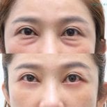 Before and after lower eyelid blepharoplasty results at Wansiri Hospital, reduced eye bags