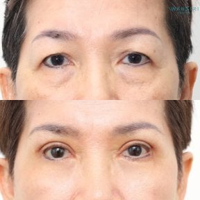 Before and after lower eyelid blepharoplasty result at Wansiri Hospital, reduced eye bags