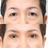 Before and after lower eyelid blepharoplasty result at Wansiri Hospital, reduced eye bags