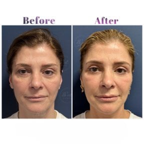 Vorher-nachher-Ergebnis des Facial Fat Transfer bei Db'est Clinic, verbesserte Gesichtskontur