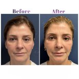 Vorher-nachher-Ergebnis des Facial Fat Transfer bei Db'est Clinic, verbesserte Gesichtskontur