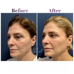 Vorher-nachher-Ergebnis des Facial Fat Transfer bei Db'est Clinic, sichtbare Volumenverbesserung