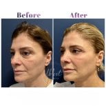 Vorher-nachher-Ergebnis des Facial Fat Transfer bei Db'est Clinic, sichtbare Volumenverbesserung