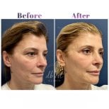 Vorher-nachher-Ergebnis der Gesichts-Fetttransplantation bei Db'est Clinic, Volumenaufbau sichtbar