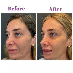 Vorher-nachher-Ergebnis des Facial Fat Transfer bei Db'est Clinic, sichtbare Volumenzunahme