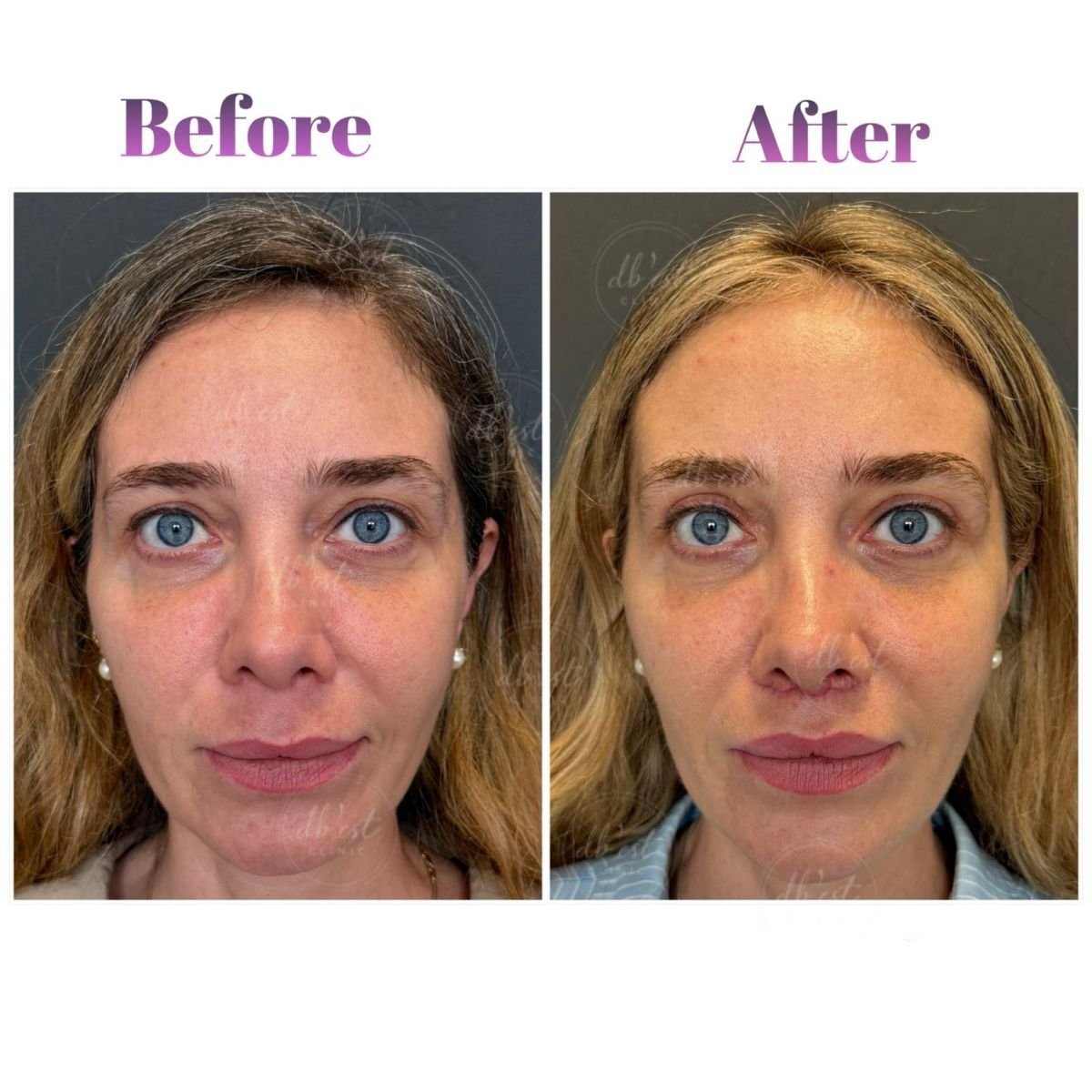 Resultados de transferencia de grasa facial antes y después en Db'est Clinic – mayor volumen facial