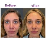 Vorher-nachher-Ergebnis der Gesichtsfetttransplantation bei Db'est Clinic – mehr Volumen