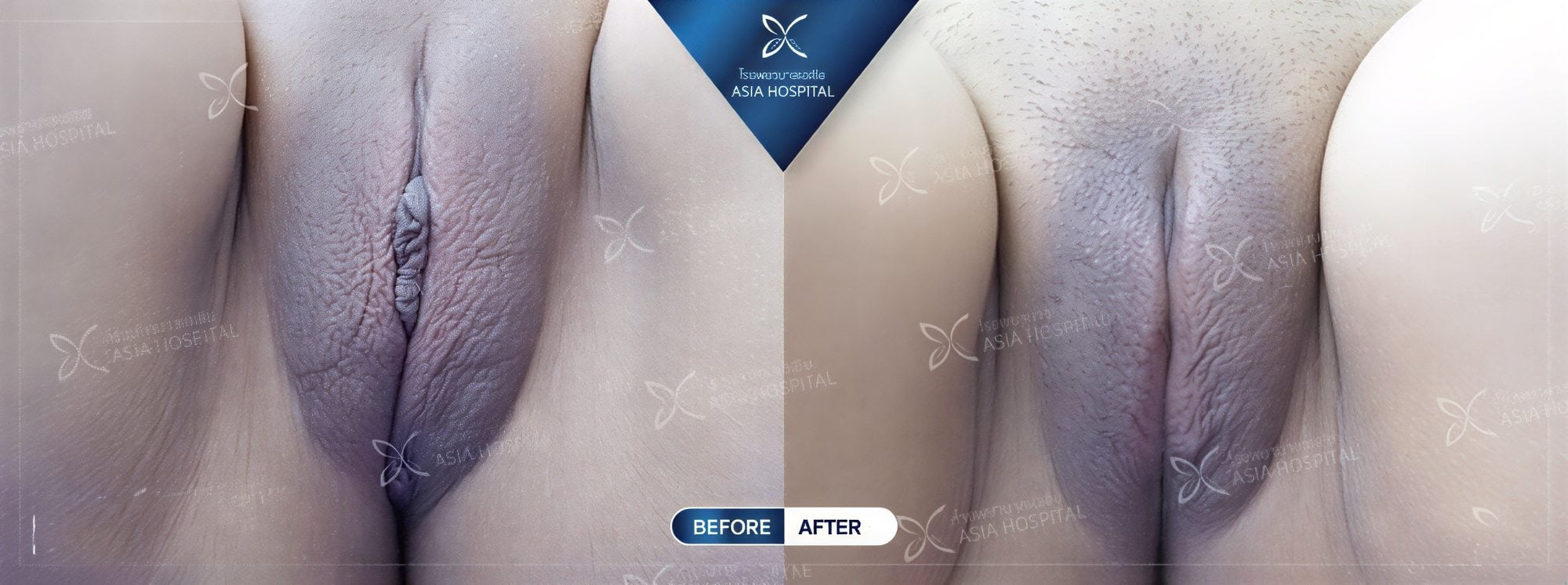Resultados de antes y después de labioplastia en Asia Cosmetic Hospital, contorno mejorado