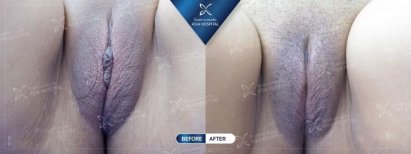 Before and after labiaplasty results at Asia Cosmetic Hospital, improved labia contour visible