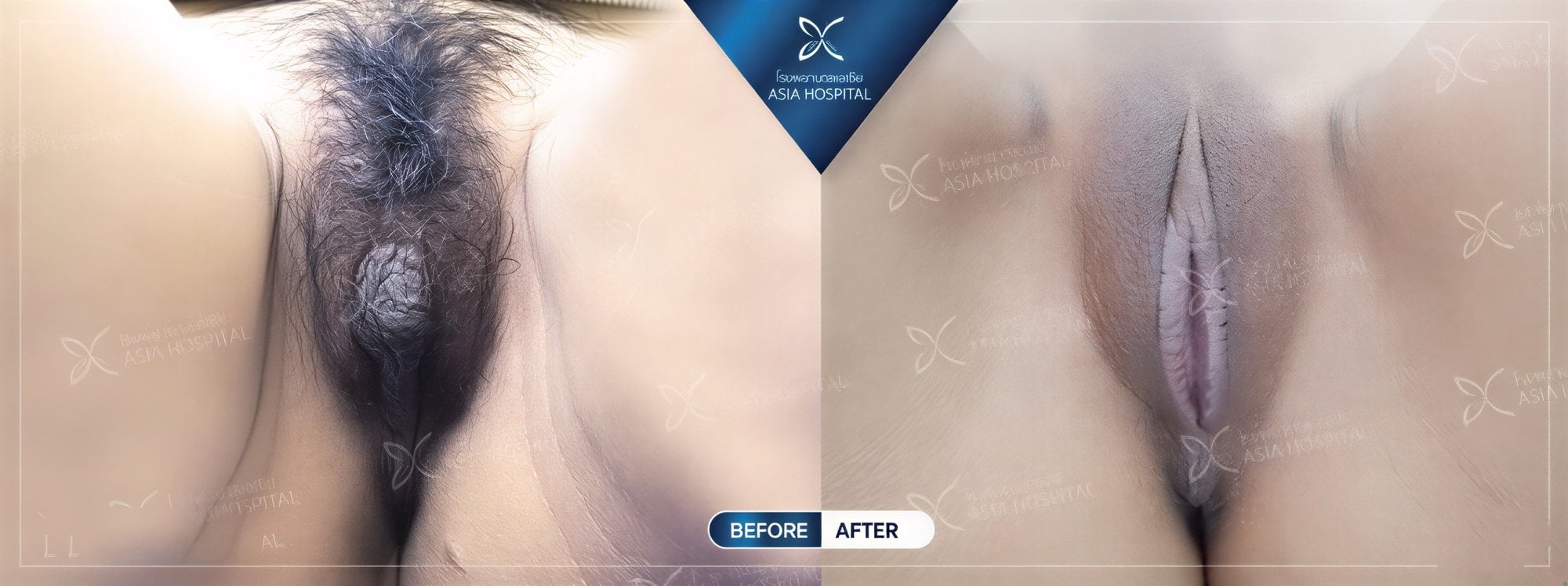 Resultados de antes y después de labioplastia en Asia Cosmetic Hospital, aspecto mejorado