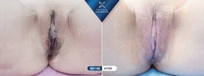Before and after labiaplasty results at Asia Cosmetic Hospital, improved labia appearance
