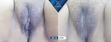 Before and after labiaplasty results at Asia Cosmetic Hospital, improved labia appearance