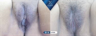 Before and after labiaplasty results at Asia Cosmetic Hospital, improved labia appearance